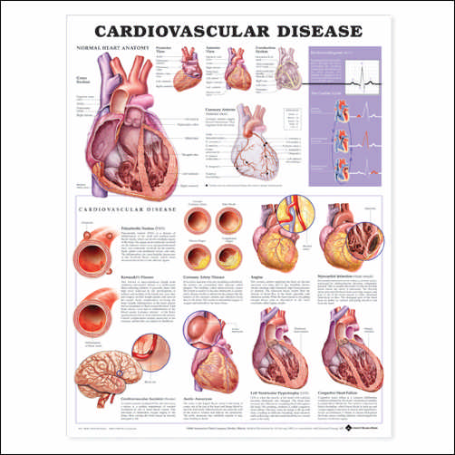 CARDIOVASCULAR DISEASE UNMOUNTED CHART - Click Image to Close