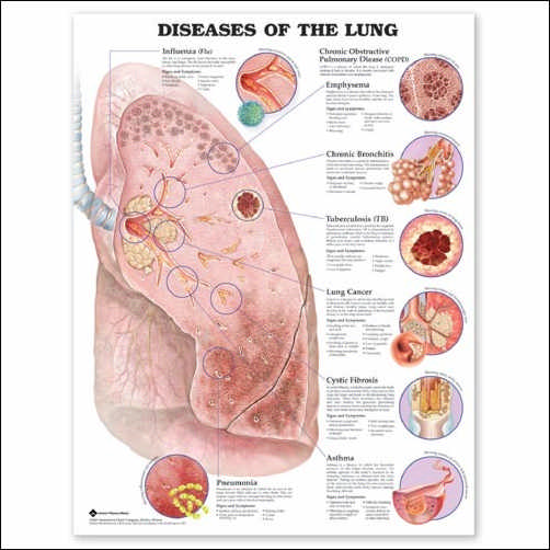 DISEASES OF THE LUNG UNMOUNTED CHART - Click Image to Close