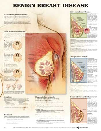 BENIGN BREAST DISEASE UNMOUNTED - Click Image to Close