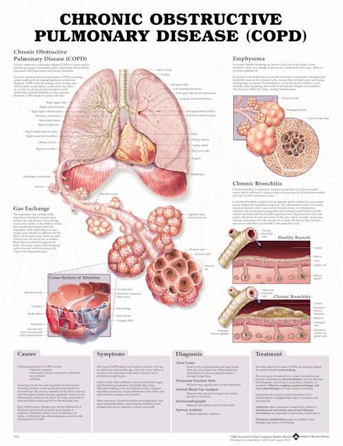CHRONIC OBSTRUCTIVE PULMONARY DISEASE (COPD) ANATOMICAL CHART -U - Click Image to Close