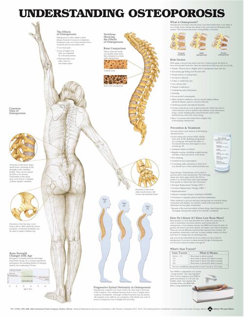 UNDERSTANDING OSTEOPOROSIS FLEXIBLE LAMINATION - Click Image to Close