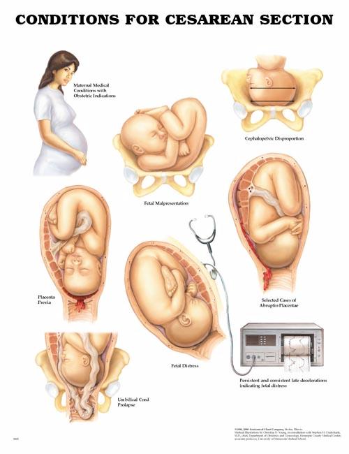 CONDITIONS FOR CESAREAN SECTION UNMOUNTED CHART - Click Image to Close