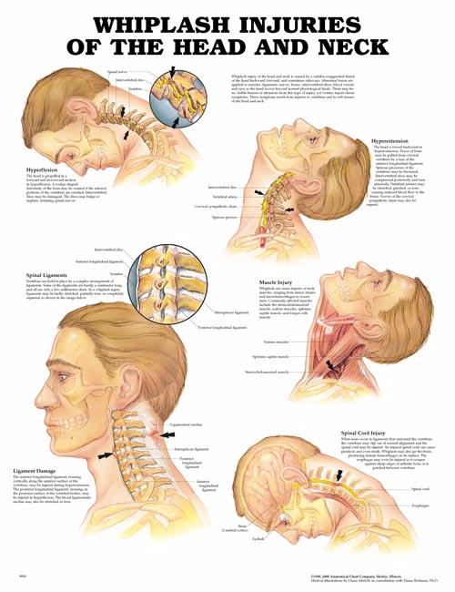 WHIPLASH INJURIES OF THE HEAD AND NECK UNMOUNTED CHART - Click Image to Close