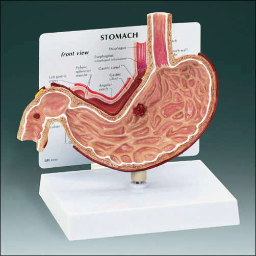 STOMACH WITH ULCERS MODEL - Click Image to Close