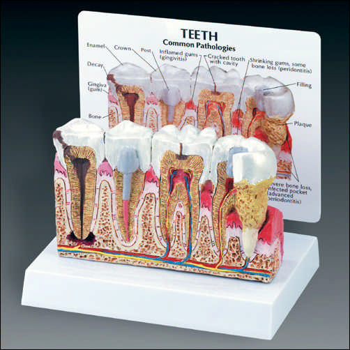 DISEASED TEETH AND GUMS MODEL - Click Image to Close