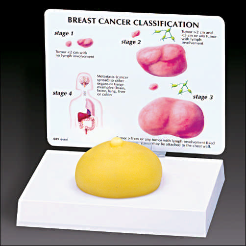 BREAST CANCER MODEL - Click Image to Close