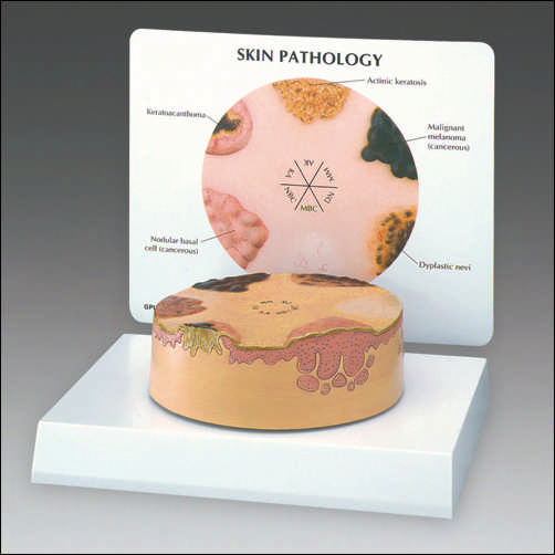 SKIN CANCER MODEL - Click Image to Close