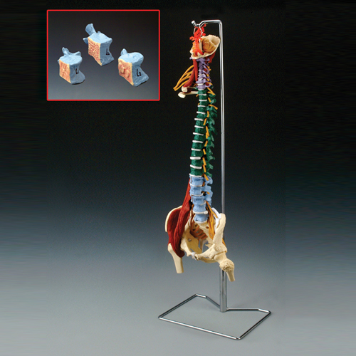 MUSCLE SPINE WITH DISORDERS WITH STAND - Click Image to Close